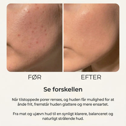 RillaMark™ PoreLift Rice Peel Serum – Synligt Renere Hud på Få Minutter